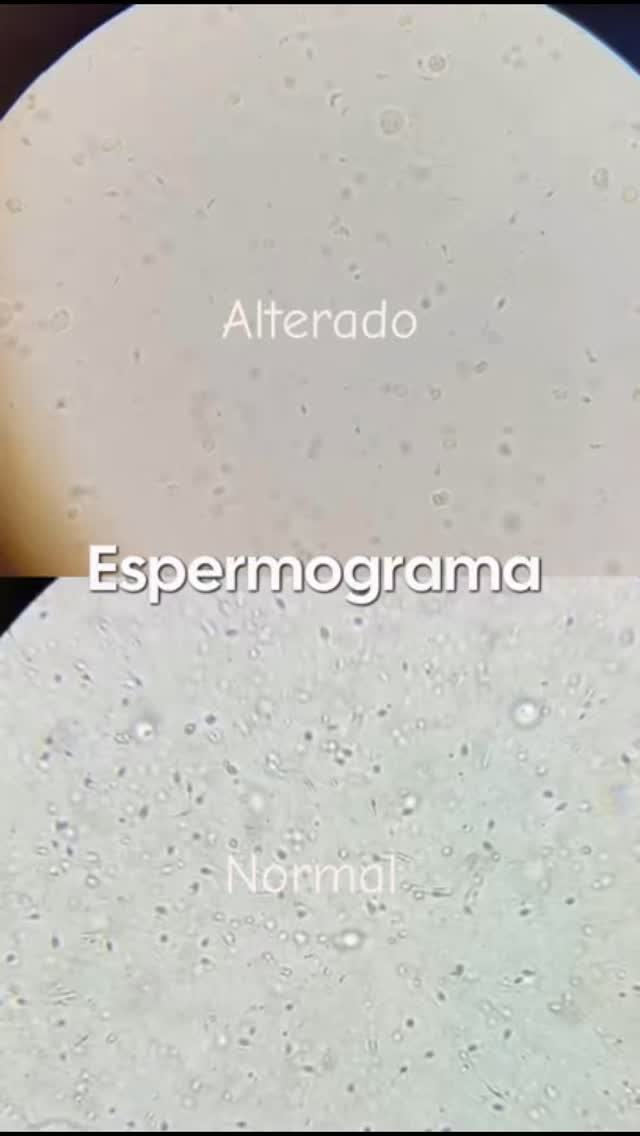 Um espermograma dentro dos padrões de normalidade e outro com alterações podem apresentar diferenças importantes, que só uma análise laboratorial criteriosa é capaz de identificar.

Aqui no Lisera Laboratórios, cada exame é realizado com precisão e qualidade, fornecendo informações essenciais para auxiliar o médico no diagnóstico e na tomada de decisão.

#lizerralaboratórios #espermograma #análisesclínicas #saúdemasculina